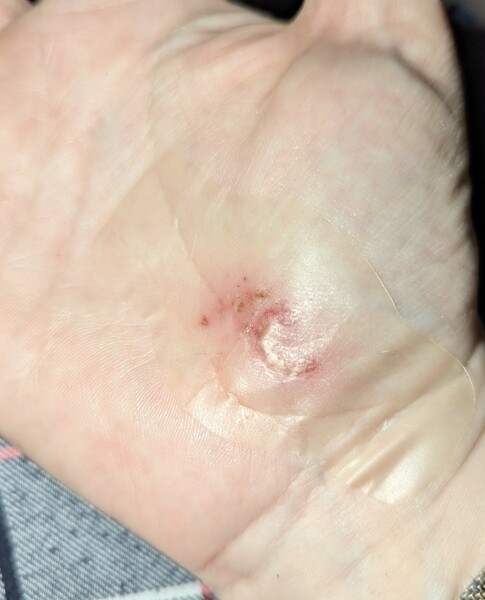 Hydrocolloid plasters