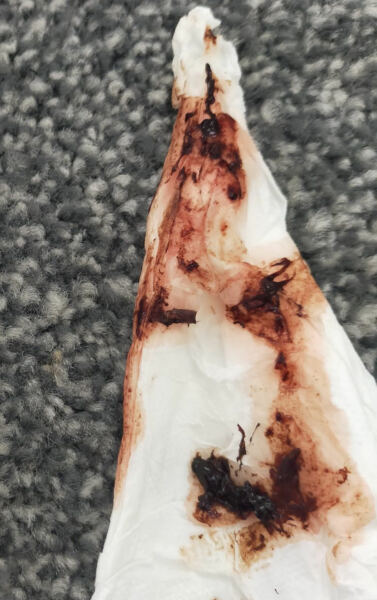 Implantation or strange period