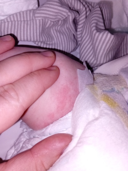 Rash on newborns leg