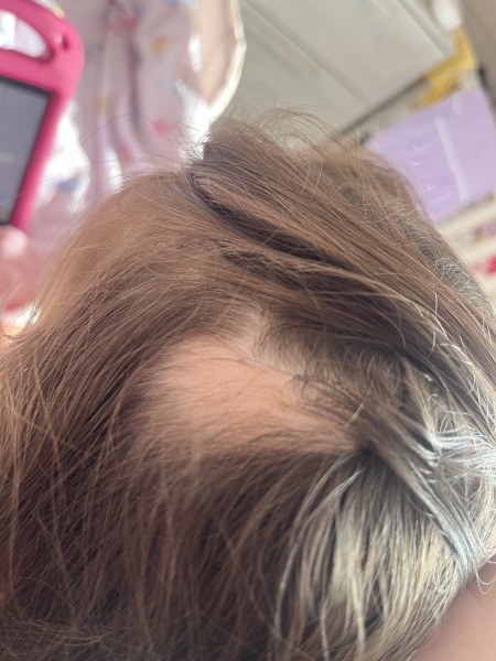 Bald spots on my 3.5 year old girls head