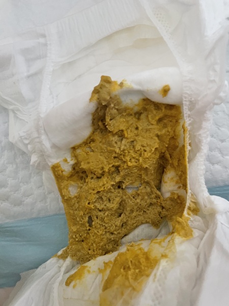 Warning poo picture - does this look like CMPA?
