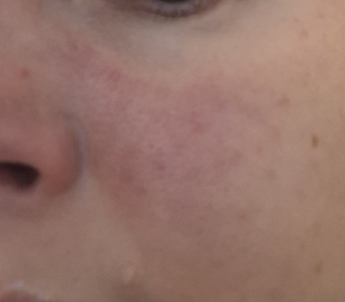Will azeylic acid deal with this redness around the nose?