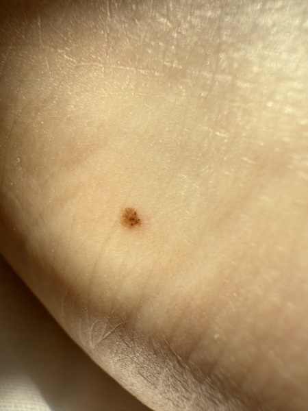 Mole on side of foot