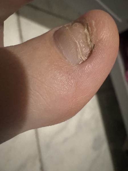 Ingrowing toenail? Nail fell off!