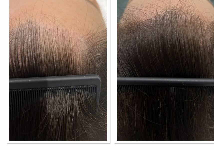 I’m having treatment for hair loss AMA