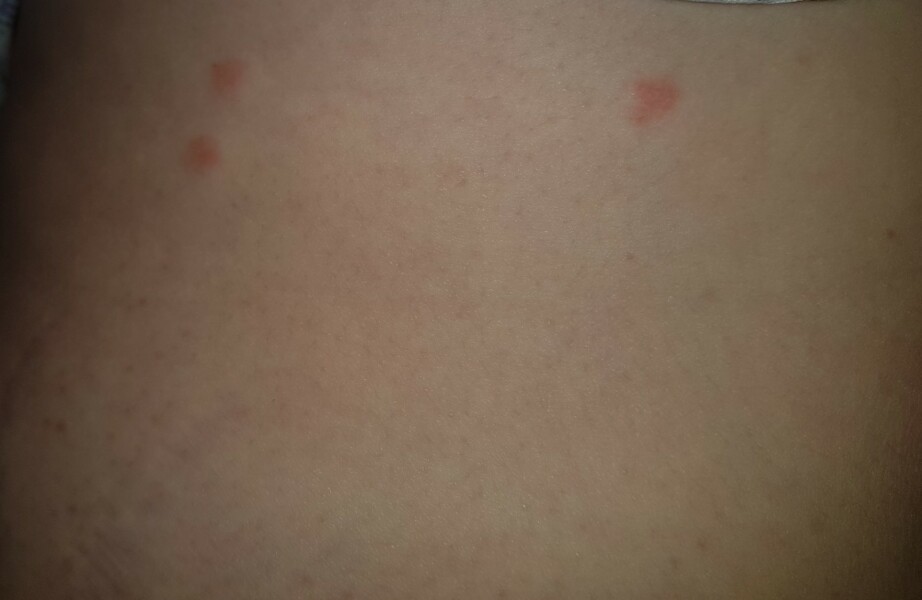 Shingles?