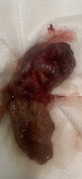 TW:graphic Miscarriage does anyone know what this is