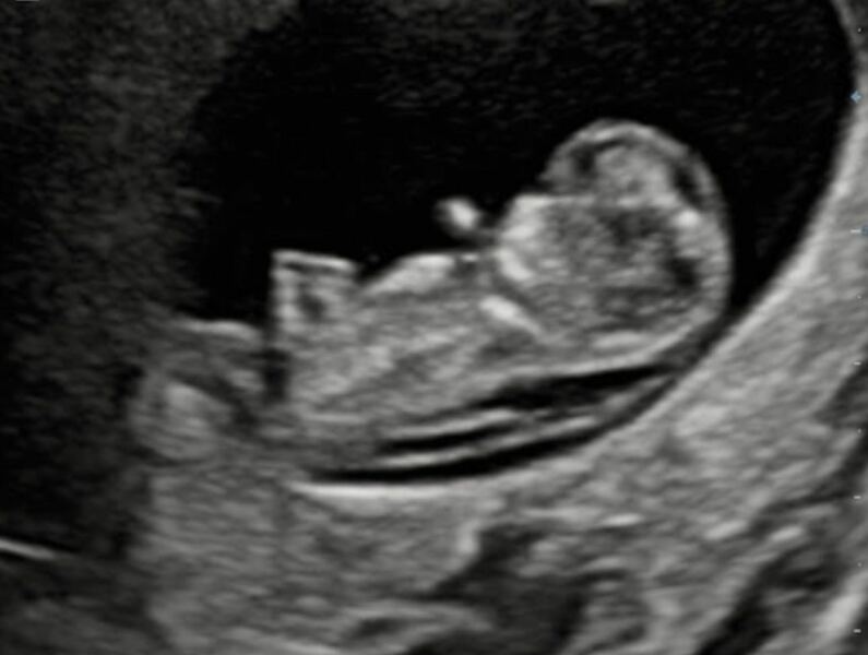 Nub theory - boy or girl ?