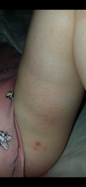 Strange rash on daughter need advice