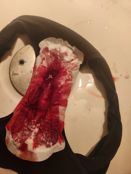 GRAPHIC PICS - Is this a miscarriage