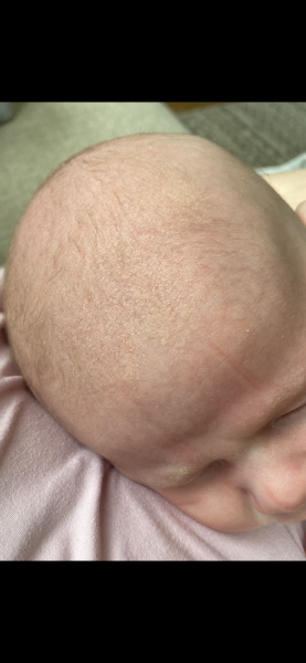 Is this cradle cap?
