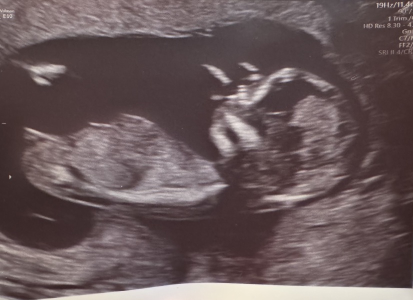 Is my baby a boy?