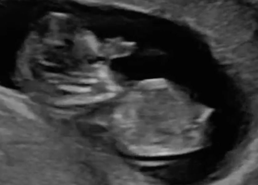 Sex of my Twin Babies