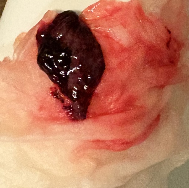 TRIGGER WARNING picture 5.2 weeks pregnant spotting for a week then heavy bleeding and clot