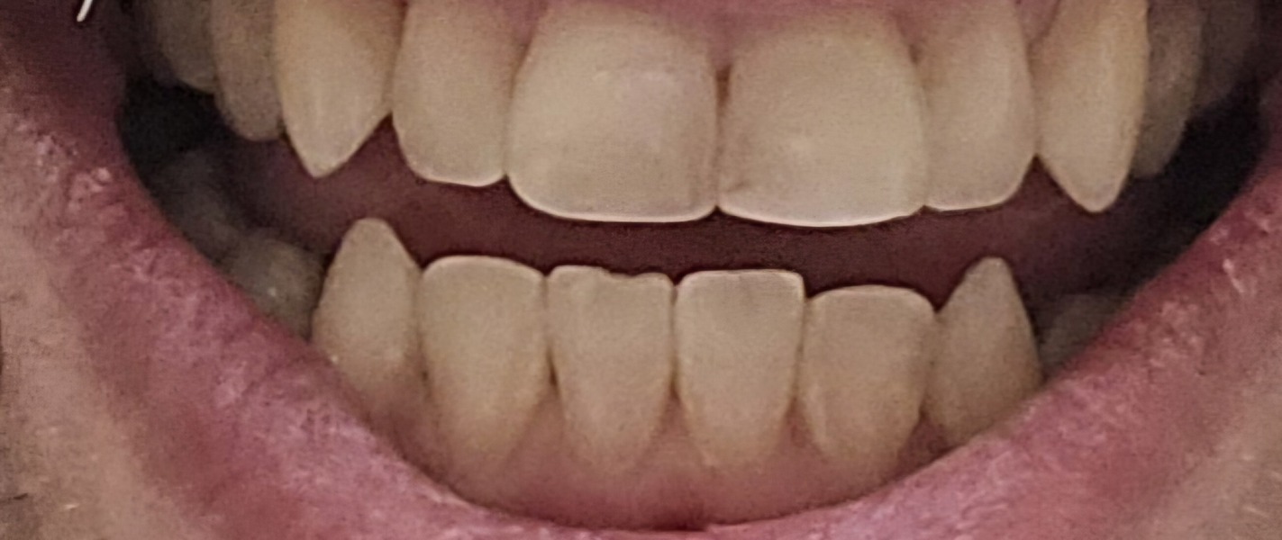 Smashed my teeth running