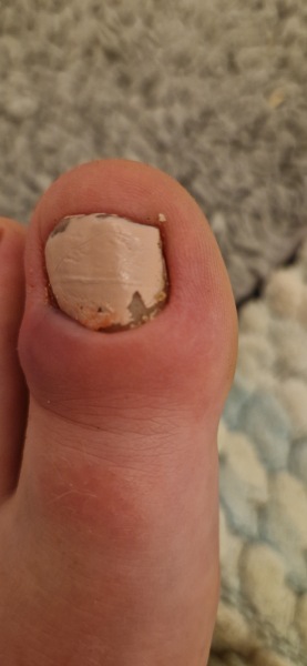 Ingrown toenail at bottom