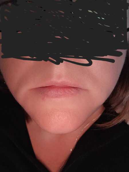 Had filler yesterday...
