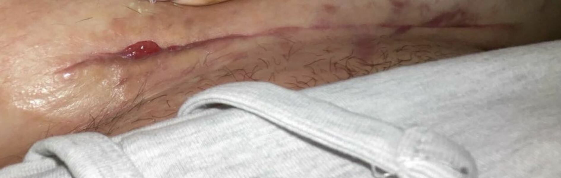 5 weeks postpartum, does my c section scar look like somethings not right? Pic attached