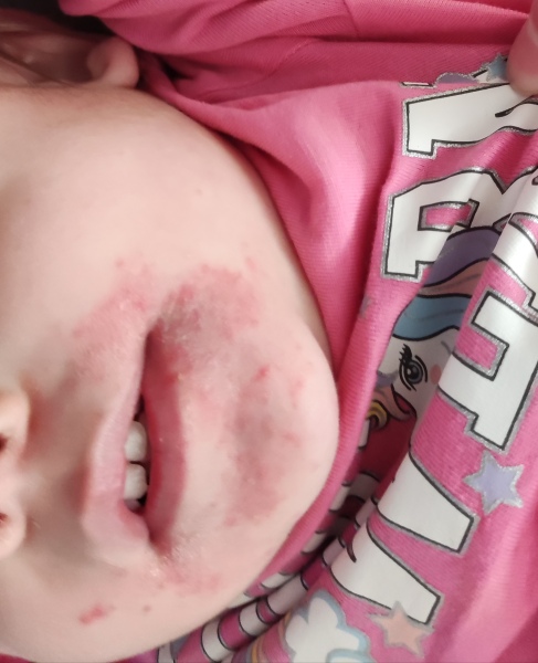 Toddler rash help. Desperate mum here