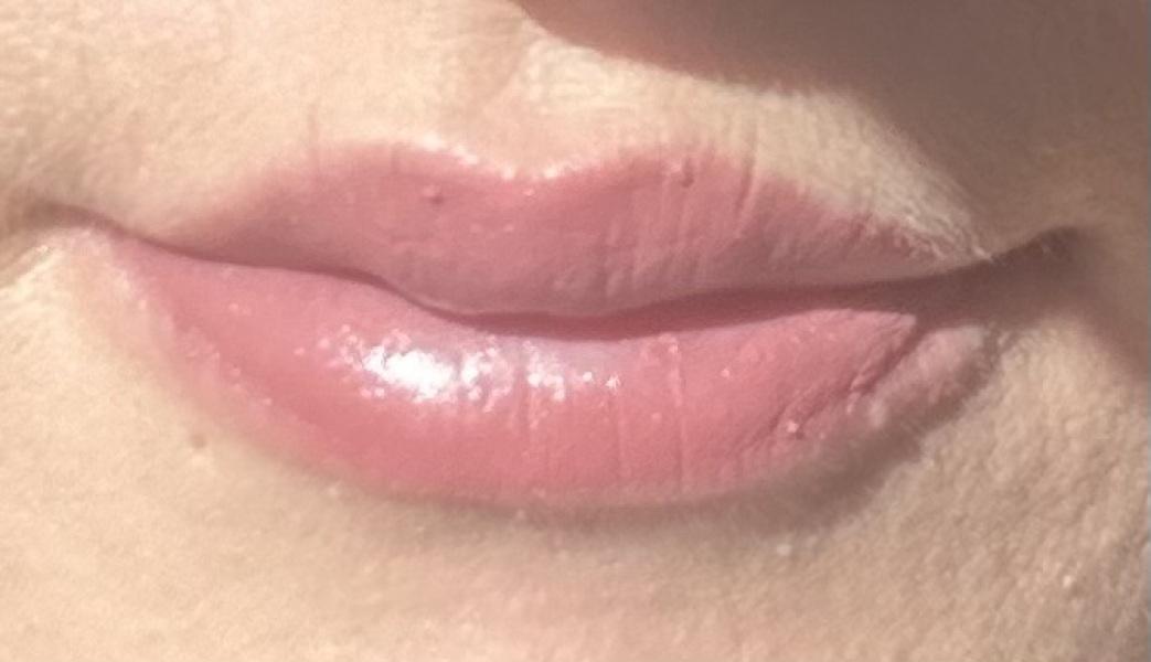 Lip lines at almost 36?