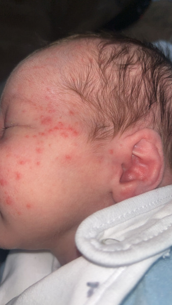 Baby acne or milk allergy.? Baby so upset after milk Pictures attached