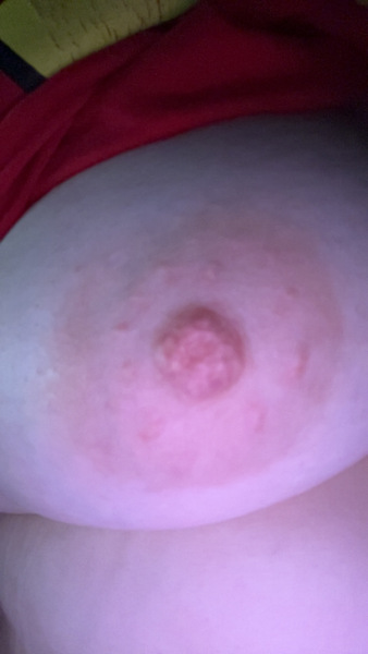 Breast lump abnormal nipples