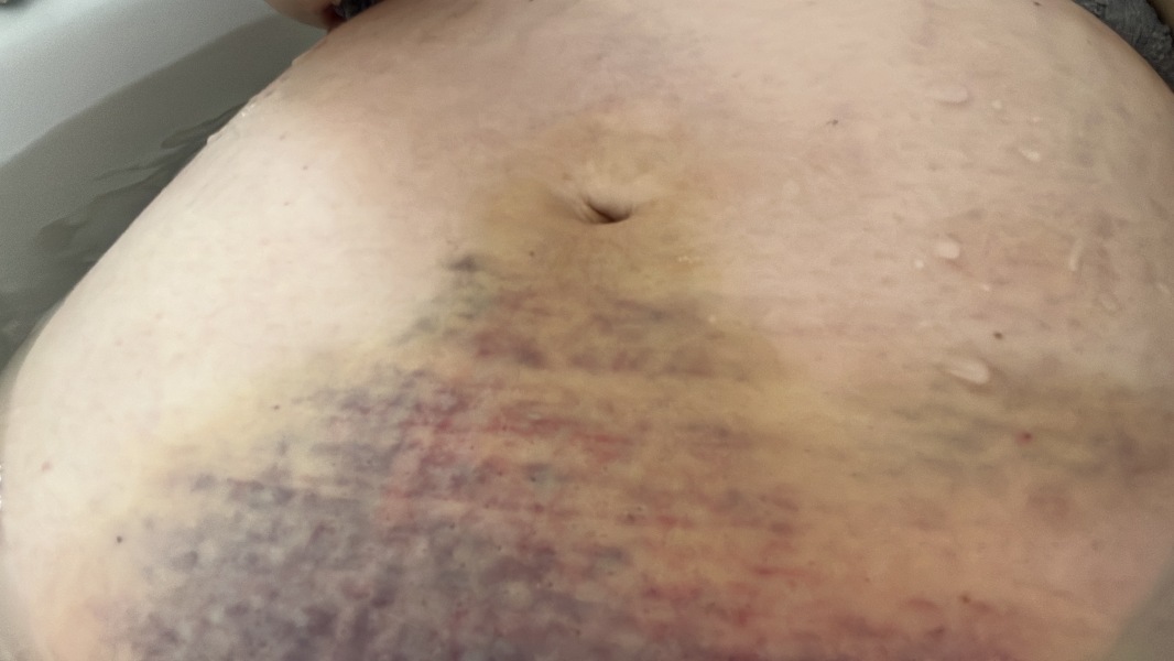 Bruising