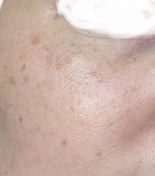 Age spots - what treatment am I thinking of? IPL?