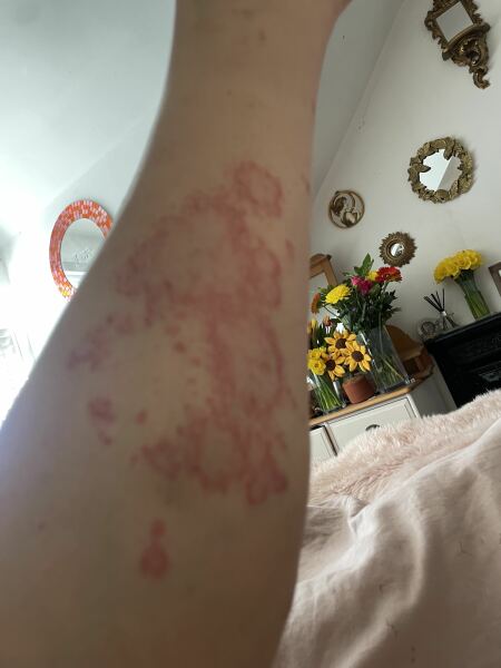 Does this look like a lupus rash?