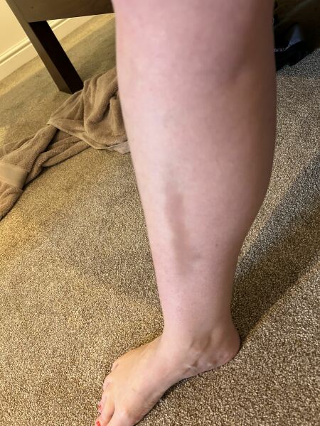Is this bruising a concern?