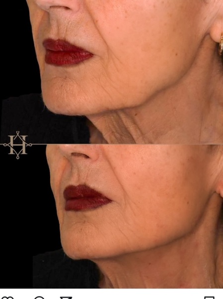 Endolift in real time, honestly.