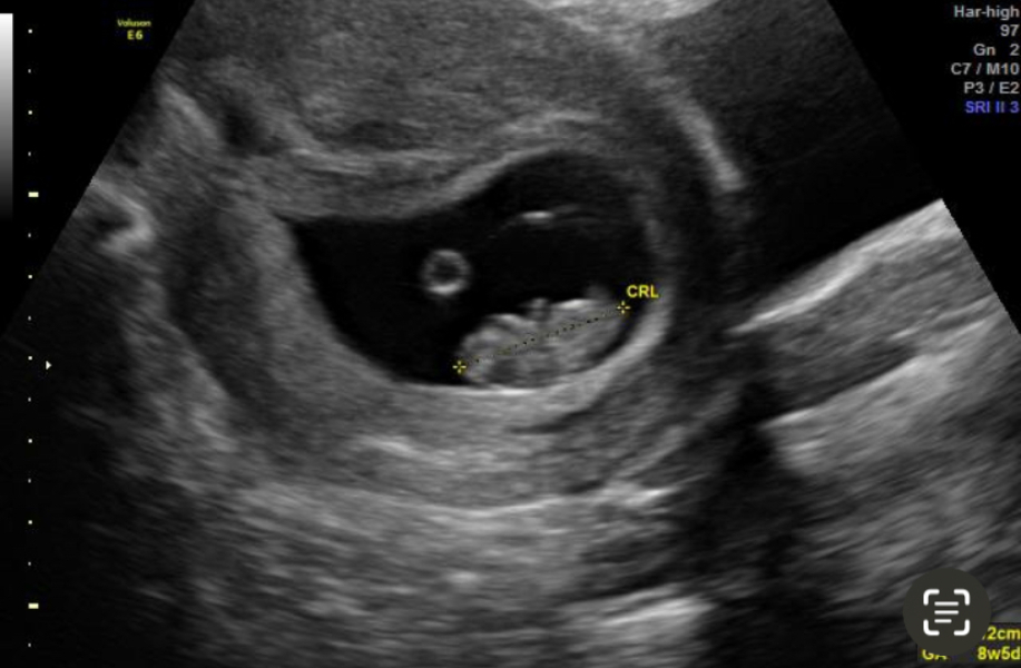 Early scan question