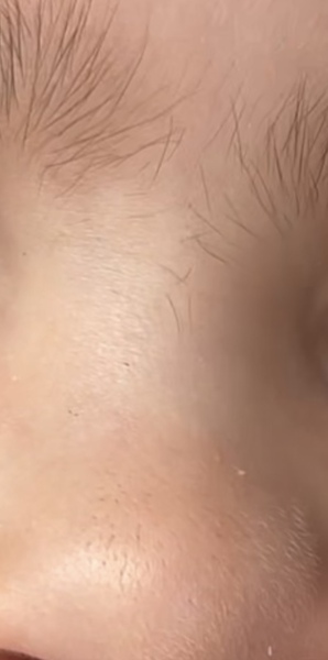 Excess hair on preschool child