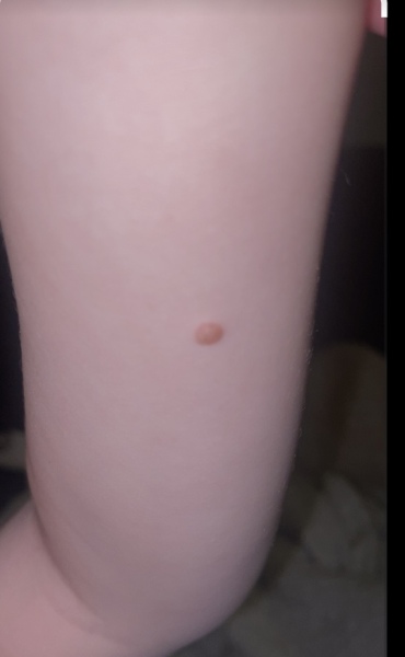 Spot on 3 year old wrist