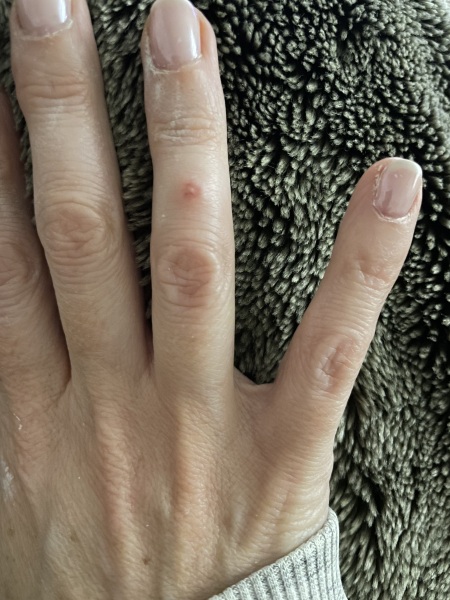 Spider bite?