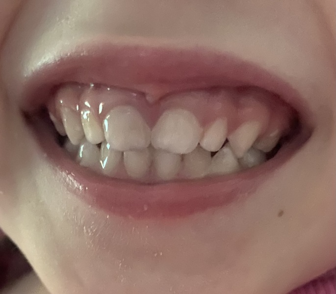 3yo knocked front teeth - discolouration - what now?