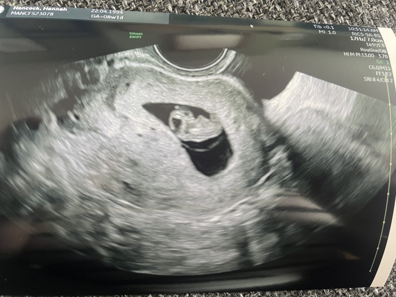 Experiences of a sub chorionic hematoma