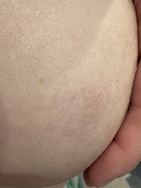 Red mark on breast
