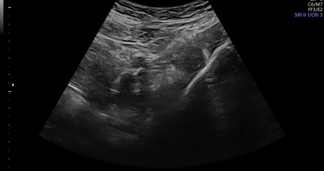 Pregnancy scan