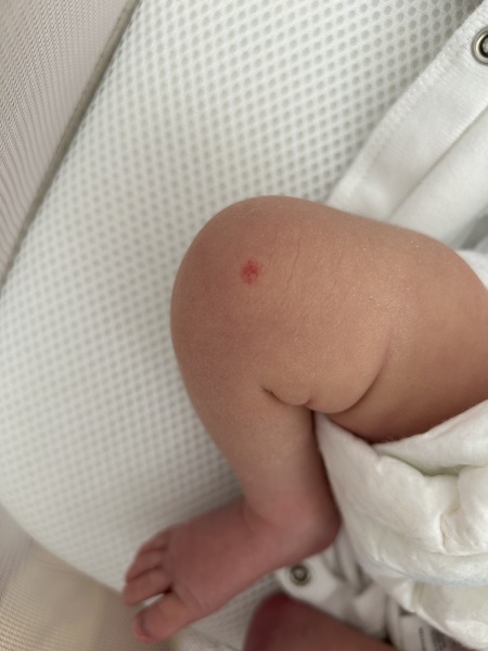 Red mark on knee
