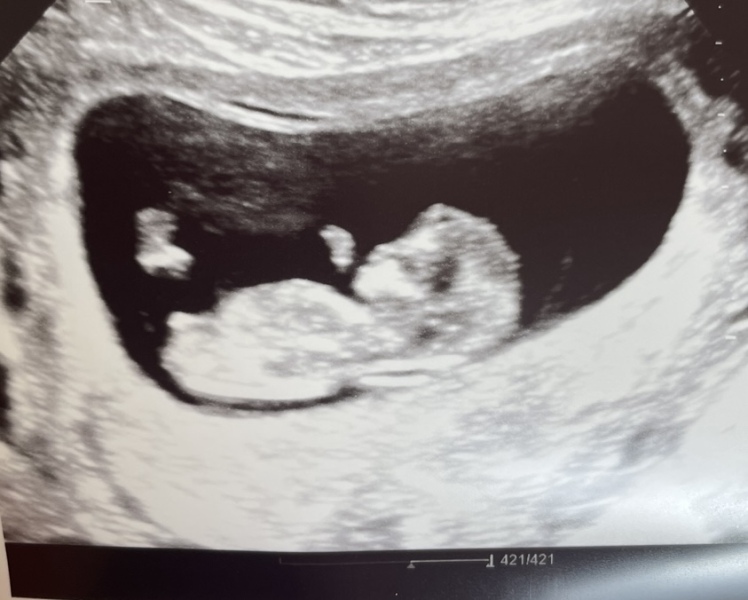Gender guesses 11 weeks