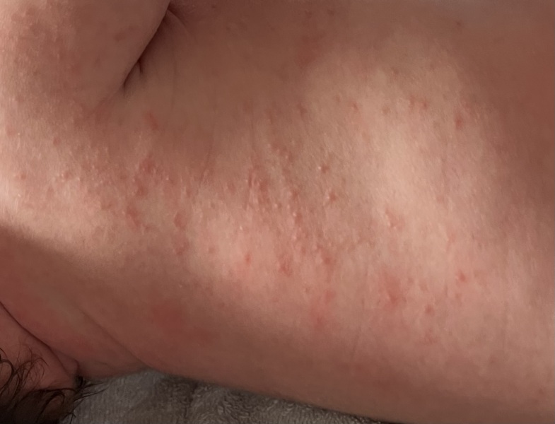 Baby have rash and diarrhoea