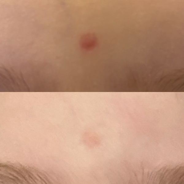 Scar on daughters forehead