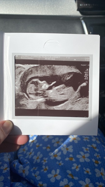 12 scan can you help me guess the gender 💙💖
