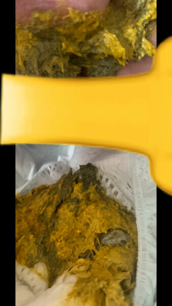 Is this colour poo normal for 10 week old? *TW GRAPHIC PICTURE*