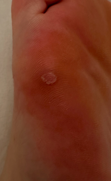 Has my verruca gone?