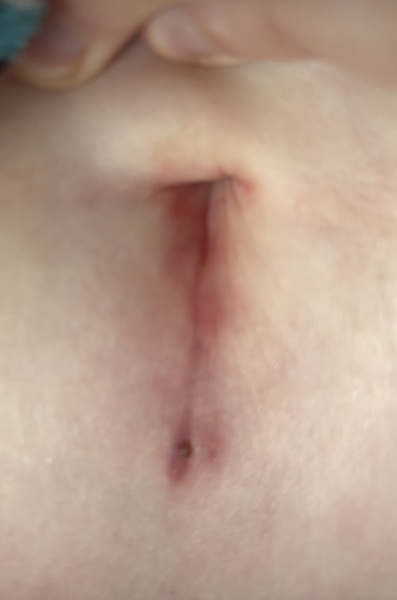 Horrible pic warning! Sorry to do this but im not sure if this is normal or infected can anyone take a look? Appendix removal