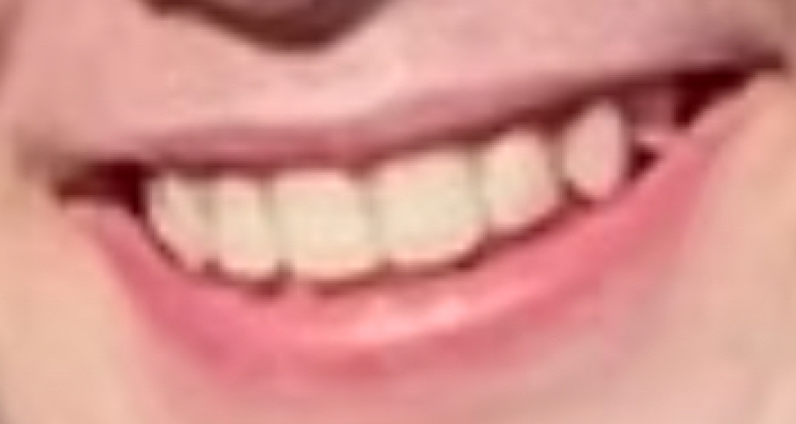 DD missing one lateral incisor