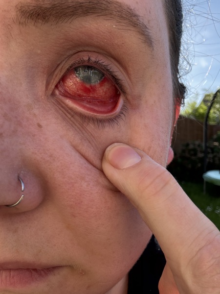 Is this redness in my eye concerning?