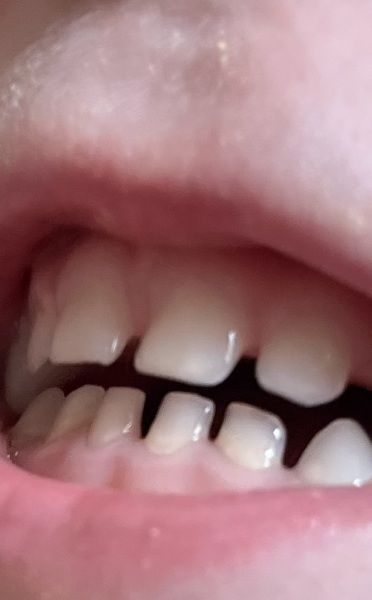 Toddler teeth help